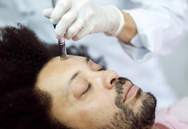 一名男子在脸上接受微针治疗.